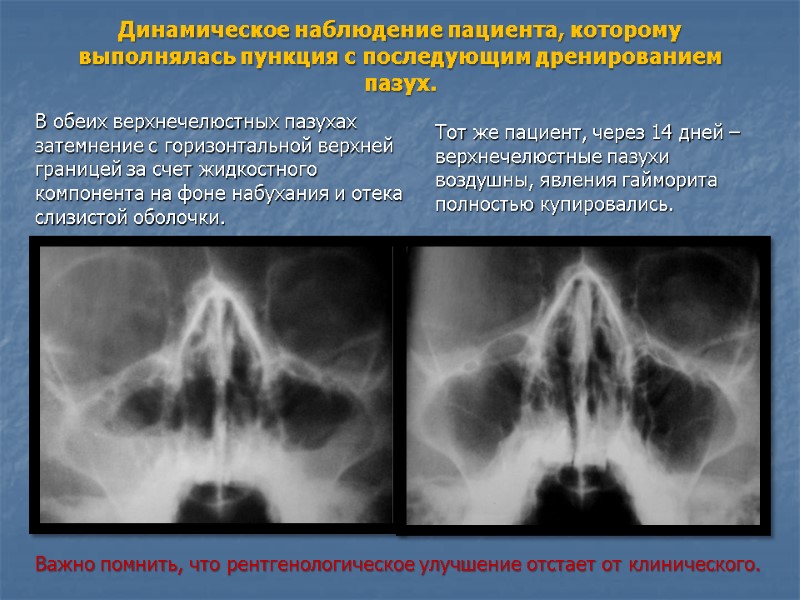 Динамическое наблюдение пациента, которому выполнялась пункция с последующим дренированием пазух.  В обеих верхнечелюстных